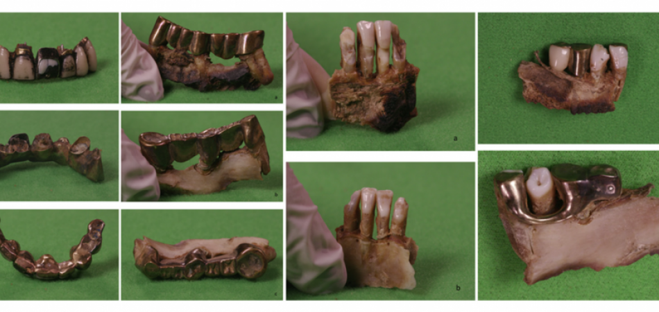 El análisis forense de los dientes de Hitler elimina las conspiraciones