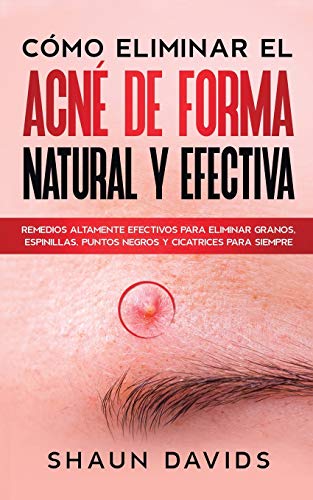 Cómo Eliminar el Acné de Forma Natural y Efectiva: Remedios altamente efectivos para eliminar granos, espinillas, puntos negros y cicatrices para siempre