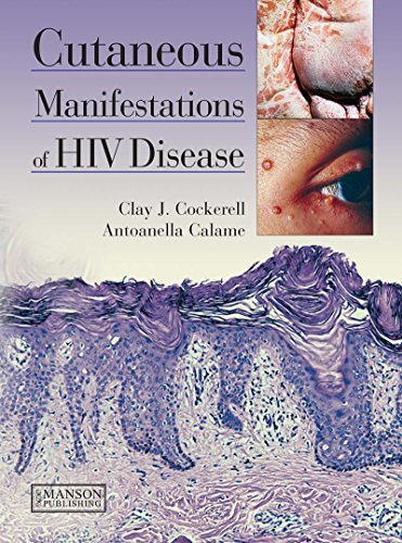 Cutaneous Manifestations of HIV Disease (English Edition)