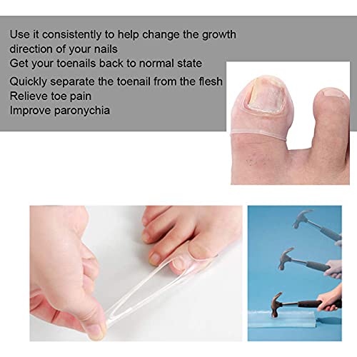 NXM Herramienta De Corrección De Uñas Encarnadas Hebilla Corrección La Uña Encarnada Y Elevador Silicona 2 Juegospara Aliviar Dolor Paroniquia Corrector Paroniquia Corrector Cuidado