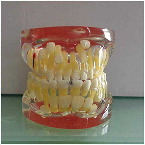 HYCy Anatomy Teeth Model - Pathologic Deciduous Teeth Model - Transparent Dental Teeth Model - Show The Deciduous Teeth,Caries and Apical Cyst Pathological Structure