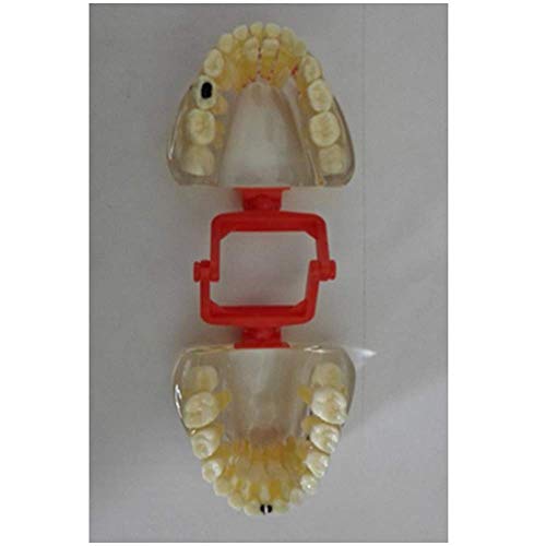HYCy Anatomy Teeth Model - Pathologic Deciduous Teeth Model - Transparent Dental Teeth Model - Show The Deciduous Teeth,Caries and Apical Cyst Pathological Structure
