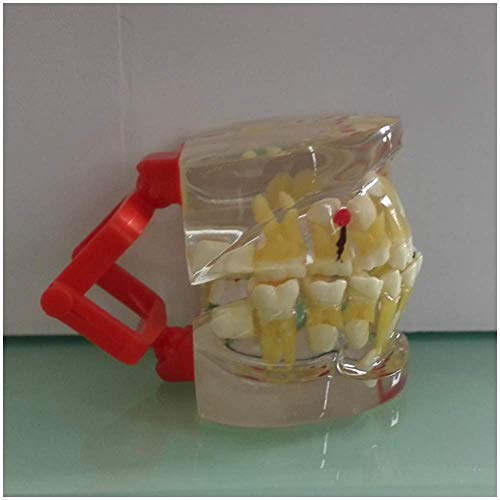 HYCy Anatomy Teeth Model - Pathologic Deciduous Teeth Model - Transparent Dental Teeth Model - Show The Deciduous Teeth,Caries and Apical Cyst Pathological Structure