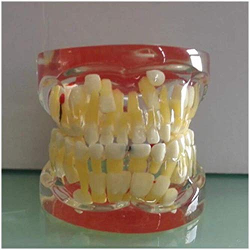 HYCy Anatomy Teeth Model - Pathologic Deciduous Teeth Model - Transparent Dental Teeth Model - Show The Deciduous Teeth,Caries and Apical Cyst Pathological Structure