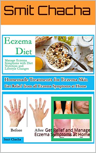 Eczema Diet Homemade Treatment for Eczema Skin Treat and Manage Eczema Symptoms: Get Relief and Manage Eczema Symptoms at Home (English Edition)